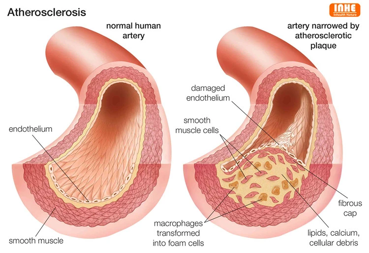What is Atherosclerosis