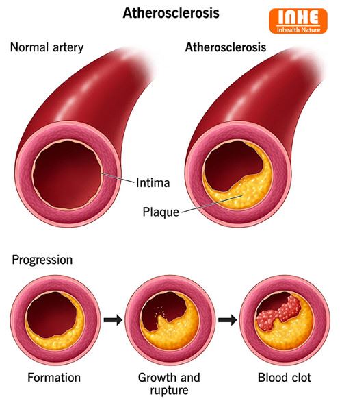 Cad iad na Forlíonta Cothaithe Ideal Do Atherosclerosis?